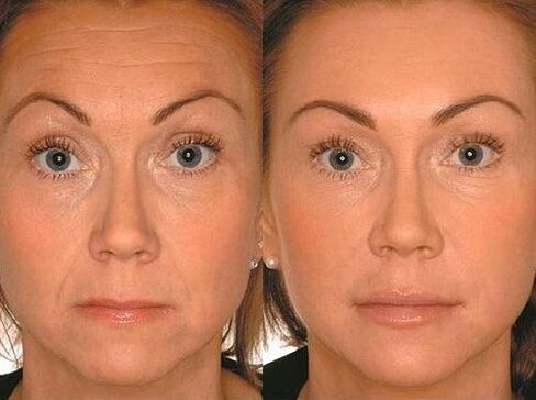 Before and after micro -treatment