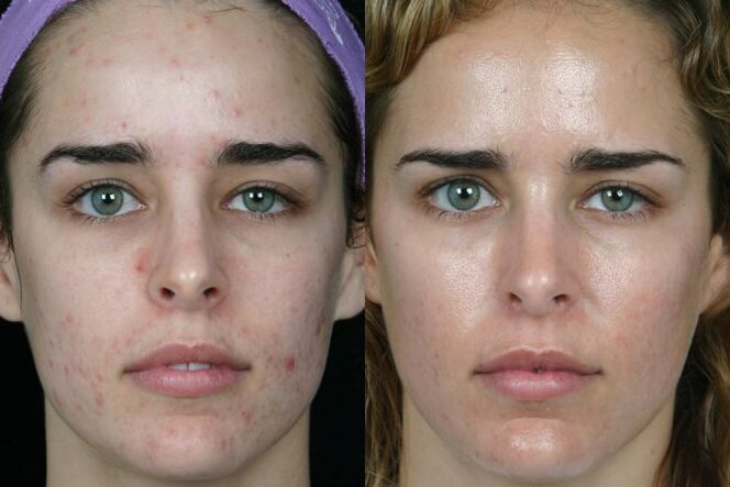 The skin grinding laser of the front and back face